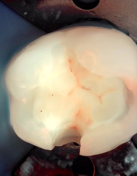 인레이치료 하방 2차 충치 레진 빌드업 사례 관련 이미지 10