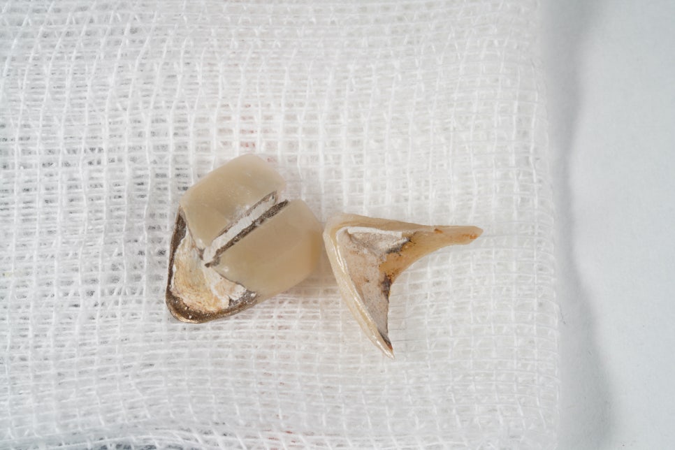 60년 전 신문배달할 때 다쳐서 씌운 앞니 크라운 변색, 지르코니아 재치료 관련 이미지 5