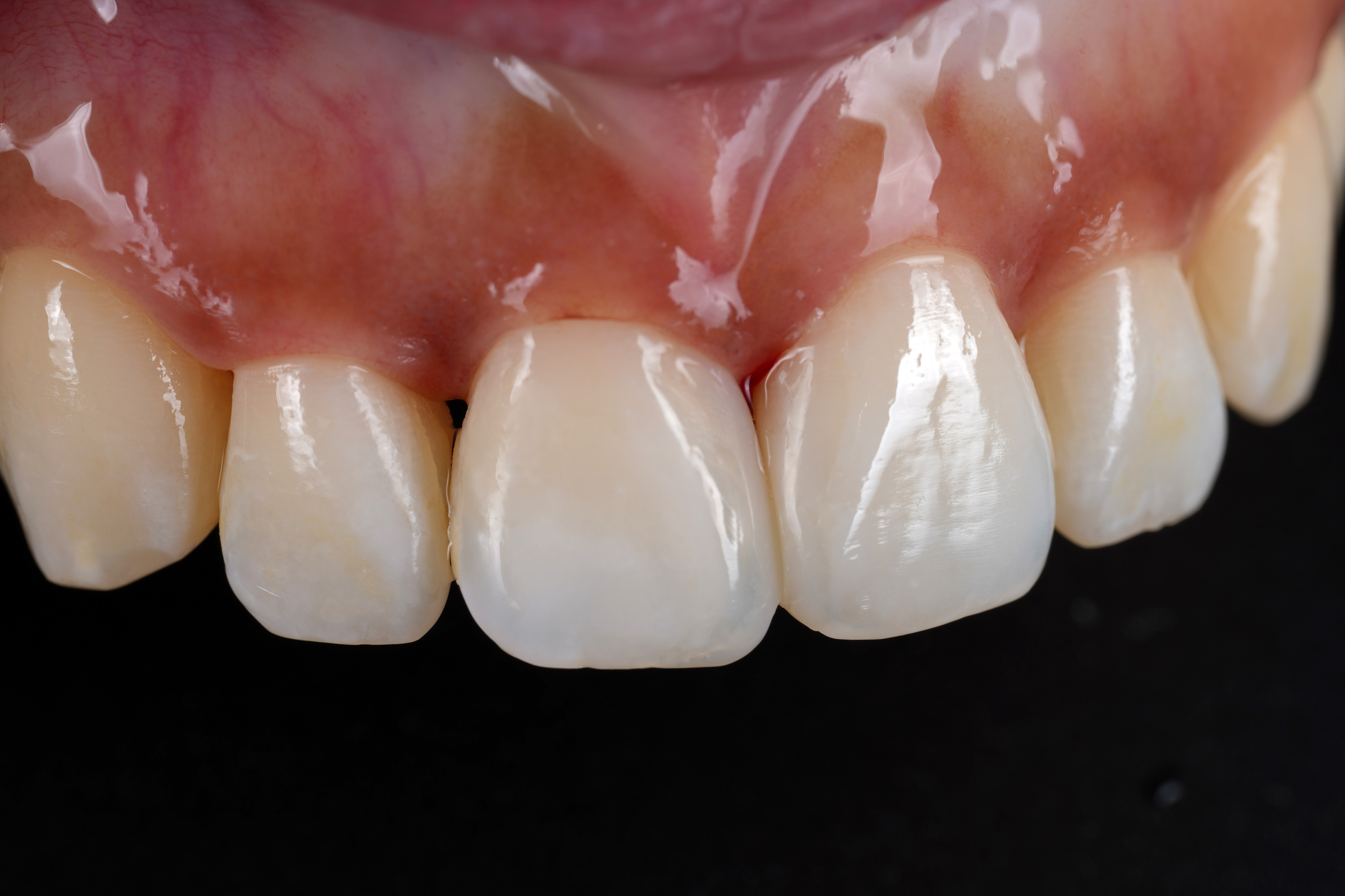 교대역 재주좋은치과 앞니 레진 비용이 저렴하지 않은 이유 관련 이미지 5