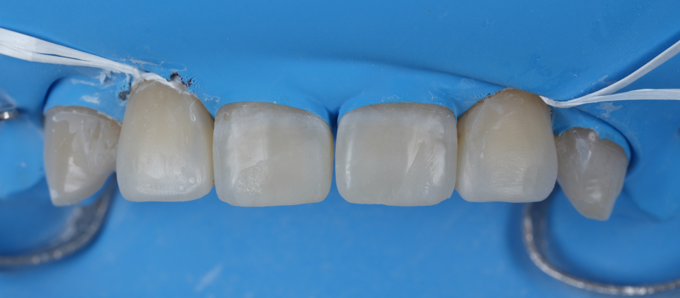 Apgujeong Dental Clinic: 3 Things Needed for Successful Resin Treatment of Peg Laterals image 10