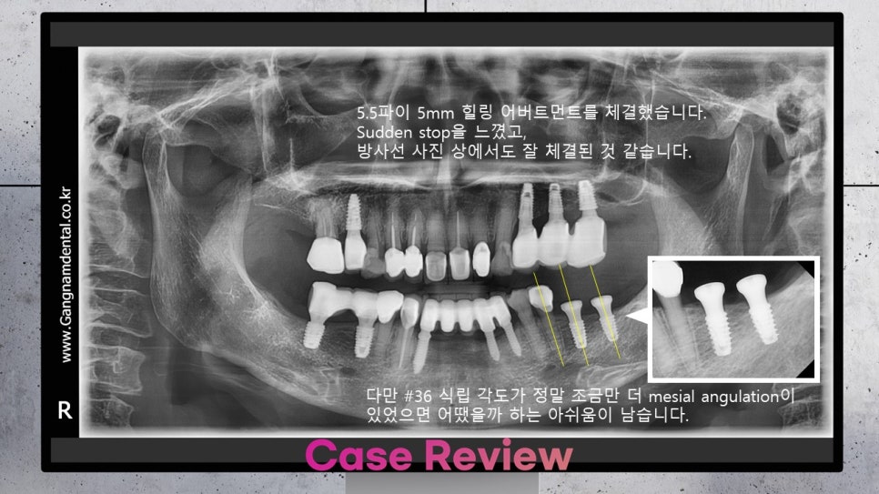 20년9월13일 / 김영삼원장님 라이브서저리 2회차 관련 이미지 3