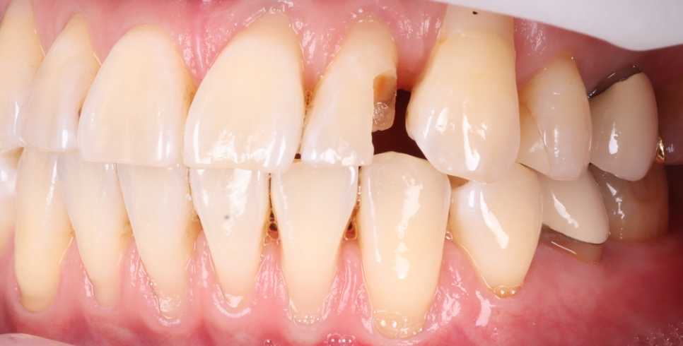 서초구치과 레진 탈락 재치료 2가지가 성공 핵심입니다 관련 이미지 4