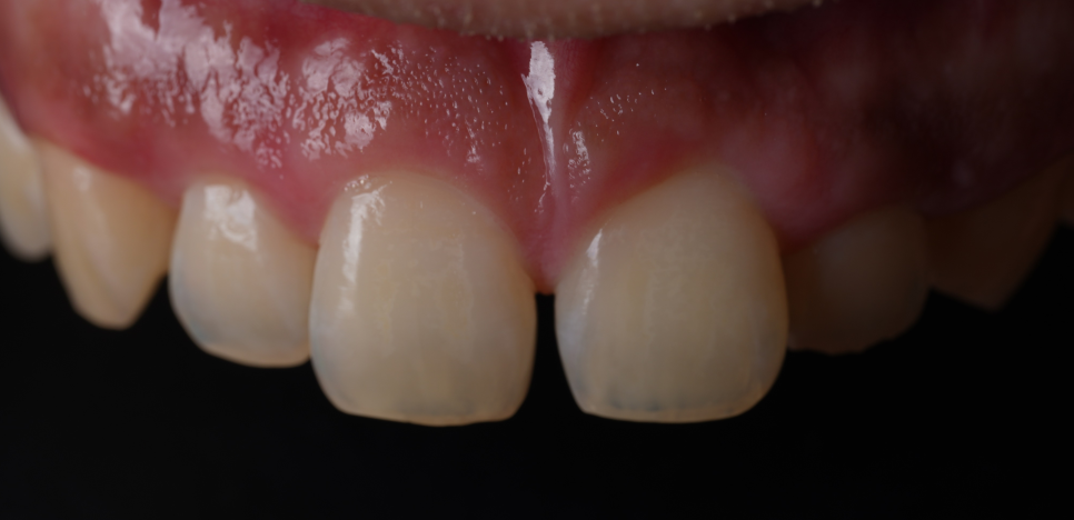 양재역치과 앞니 레진 받으러 수원에서 오신 이유(feat. 치과의사 소개) 관련 이미지 3