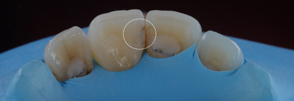 고속터미널역치과 레진치료 처음부터 잘 받아야 하는 이유 관련 이미지 3