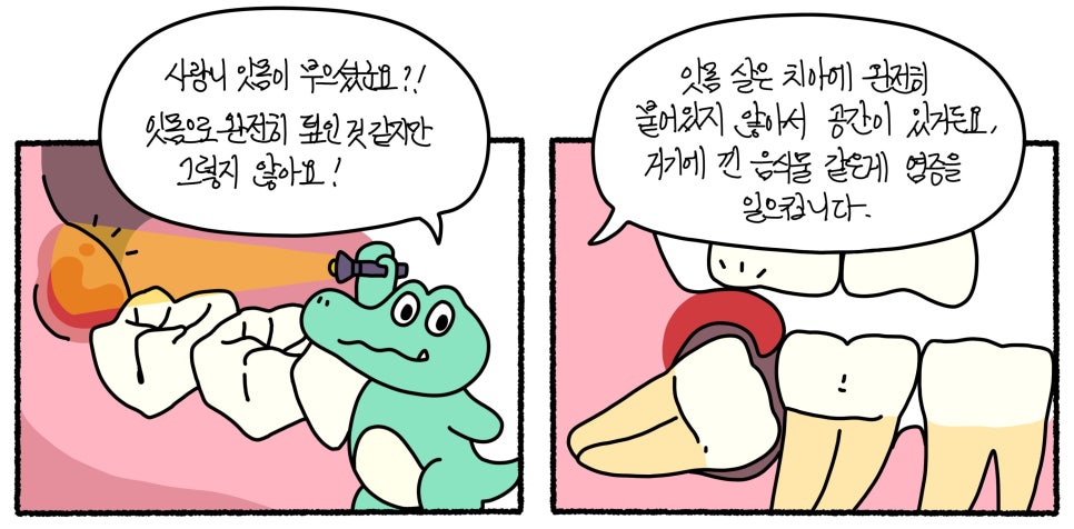 하악 매복 사랑니 발치 이야기, 조상님 묘 칡 캐듯 뽑기 (비외상성 발치) 관련 이미지 3