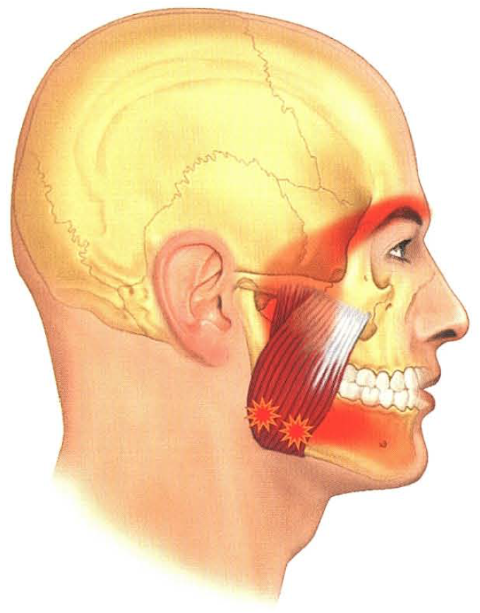 턱이 아픈데 어깨를 치료하라고요? 관련 이미지 1