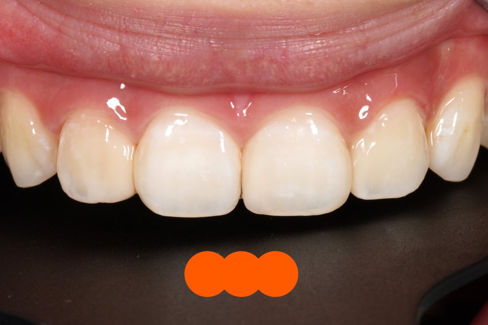 교대역, 교정 끝나고 앞니 사이 충치 레진 재치료 (유지장치 붙이기 전에 오세요) 관련 이미지 6