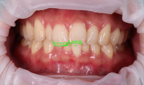 왜소치 레진으로 삭제 없이 예쁘게 관련 이미지 9