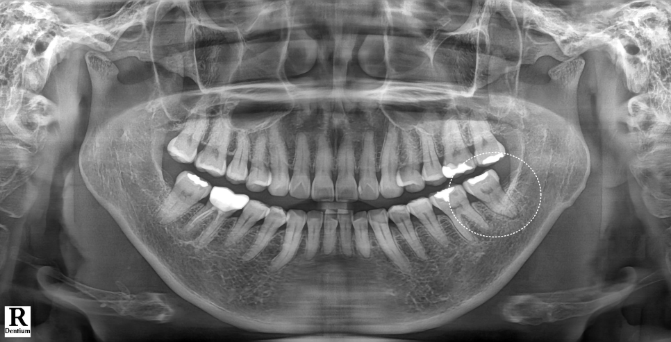 Gangnam Dental Clinic: You Wanted an Extraction, but We Preserved the Tooth with Root Canal Treatment + Overlay image 2