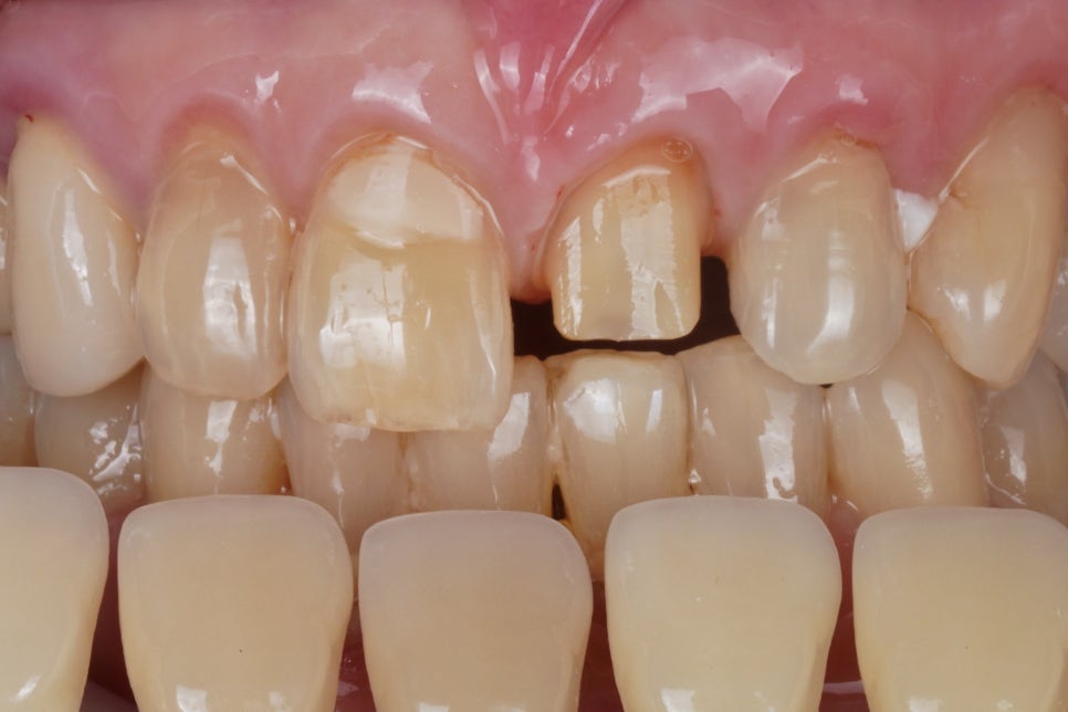 넘어져서 빠질 뻔한 앞니를 신경치료해 지르코니아 크라운으로 살린 케이스 관련 이미지 4