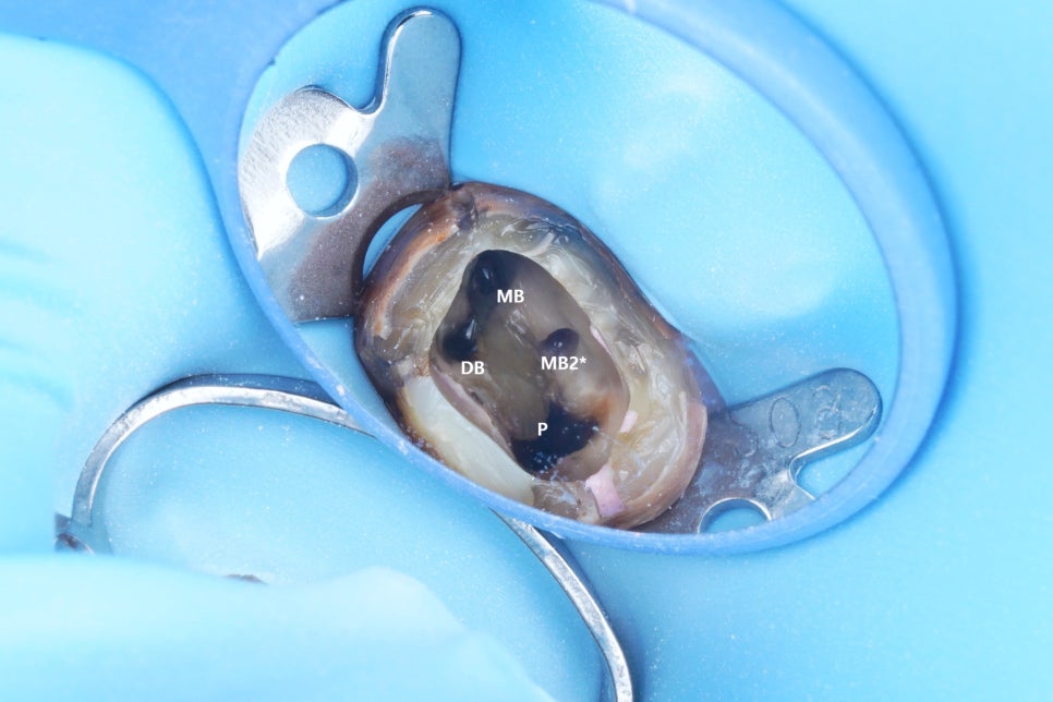 부모님(아버지) 어금니 재신경치료 해드린 썰 푼다.txt 관련 이미지 3