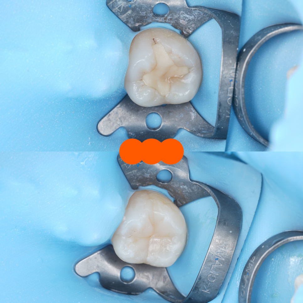 교대역치과 타치과 신경치료, 크라운 진단받았으나 레진으로 치료 관련 이미지 18