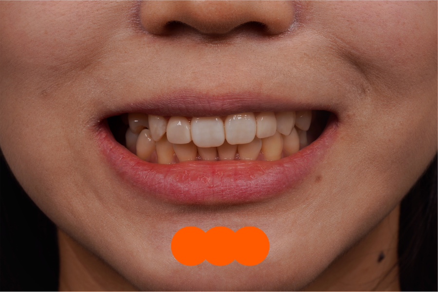 왜소치 레진 라미네이트, 당일 치료 완료! Direct composite veneer하는 서초동 치과 관련 이미지 6