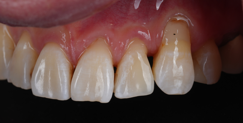 서초구치과 레진 탈락 재치료 2가지가 성공 핵심입니다 관련 이미지 10