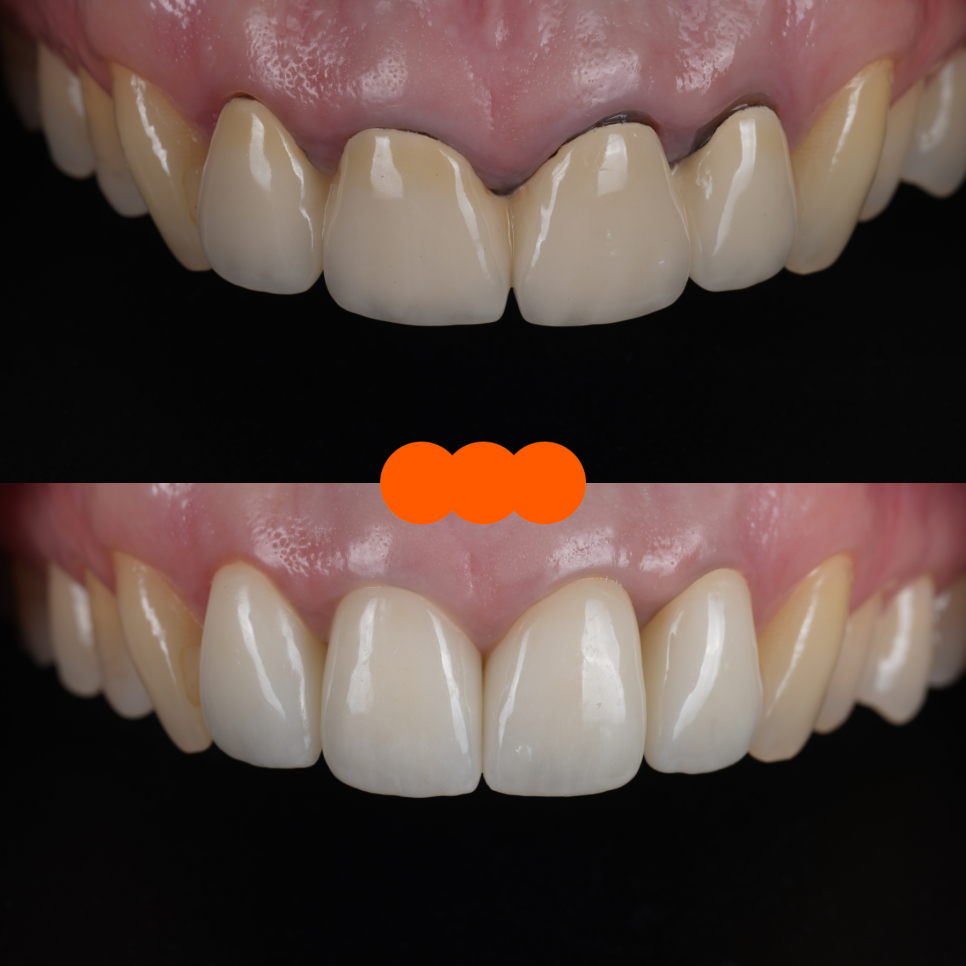 신논현치과 외국인 까만 앞니 크라운 교체 사례 관련 이미지 22
