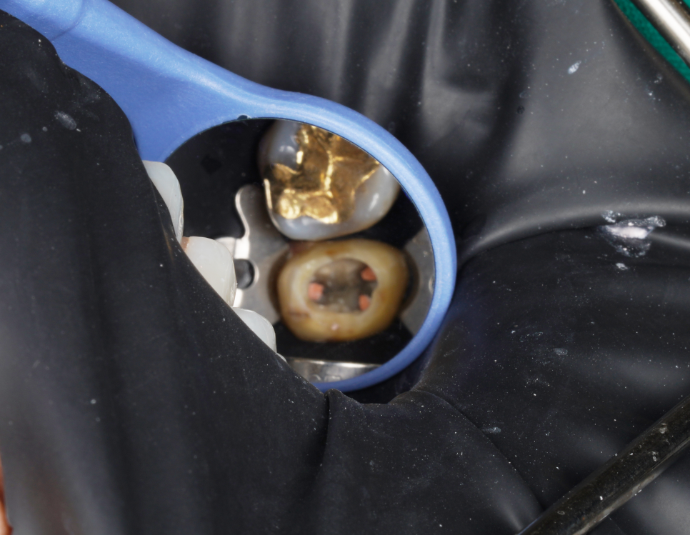 동기 치과의사의 부탁으로 어금니 신경치료만 마무리 해드린 케이스 관련 이미지 5