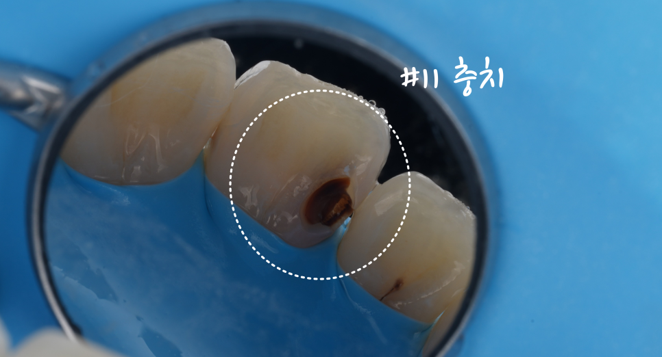 교대역치과 타치과 신경치료, 크라운 진단받았으나 레진으로 치료 관련 이미지 4