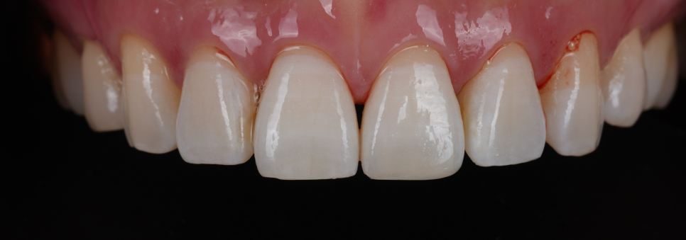 강남치과 짧아 보이는 치아 레진으로 당일 치료 관련 이미지 10