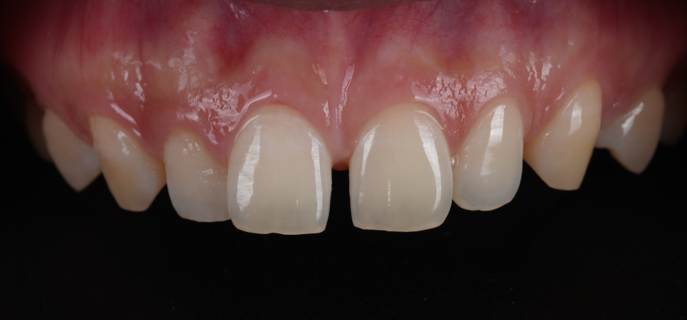 블랙트라이앵글 자연스럽게 메우는 비결은 이것 관련 이미지 8