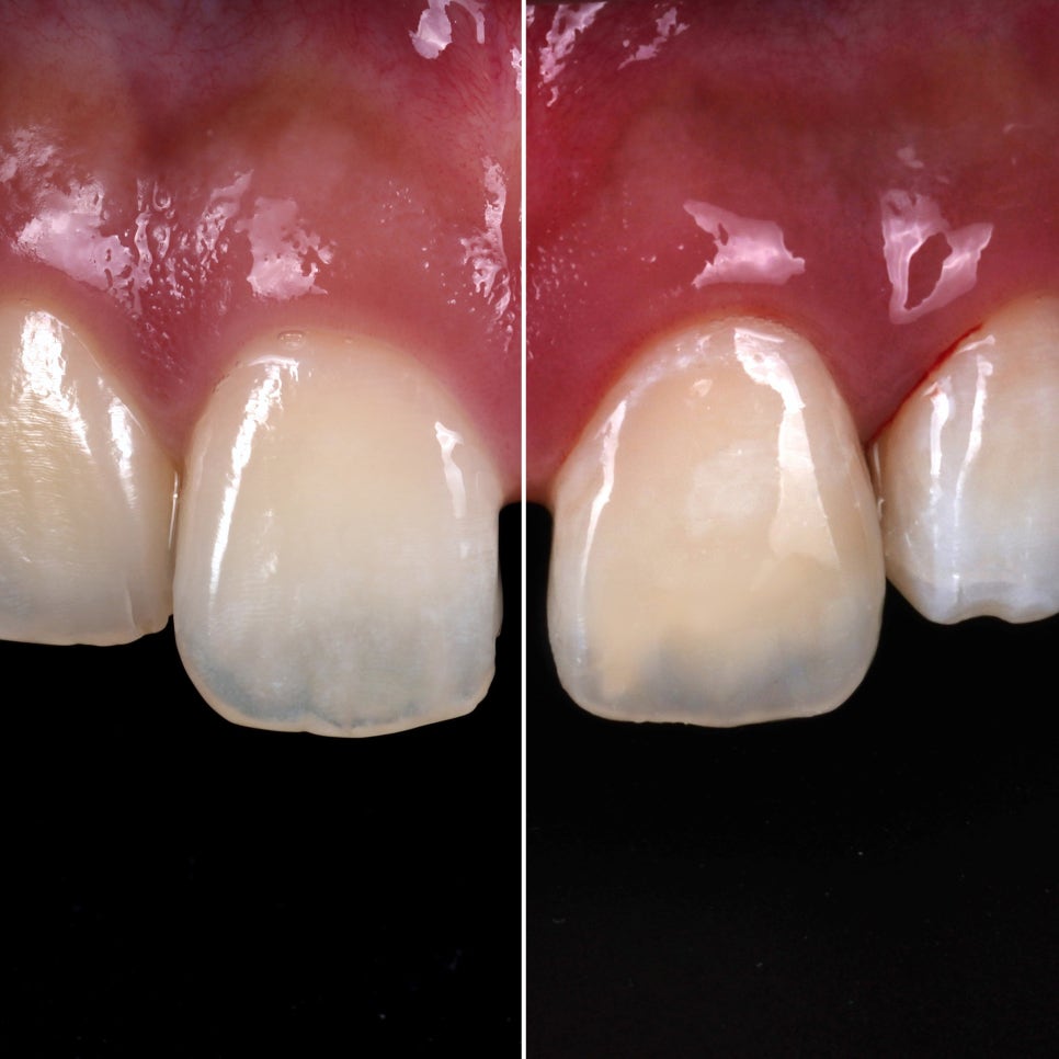 앞니 부러짐 레진, 크리스마스 이브날 앞니 복원 관련 이미지 3