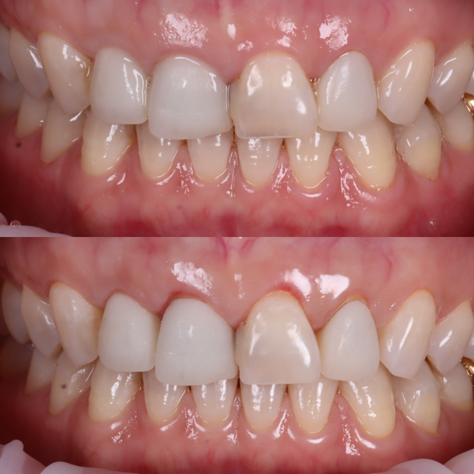 라미네이트, 크라운 재치료, 잇몸 성형까지 앞니 6개 치료 관련 이미지 8