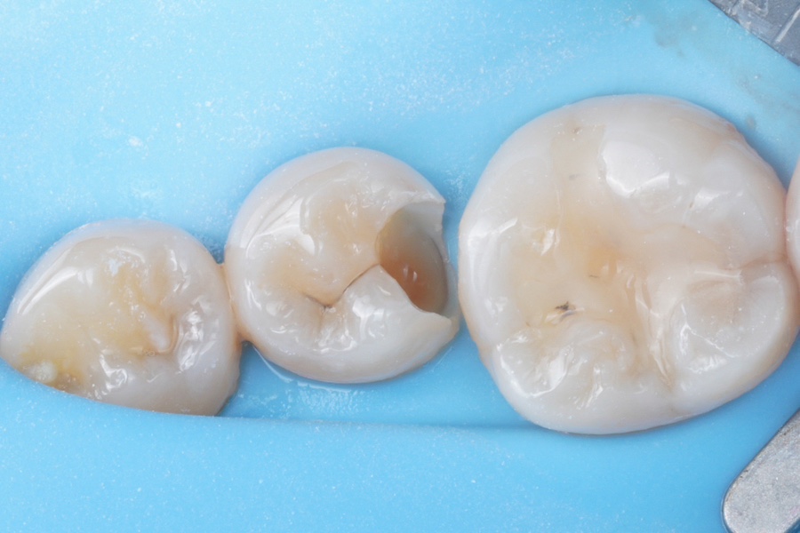 신경치료 할법한 어금니를 레진 빌드업으로 살려가는 이유 관련 이미지 11