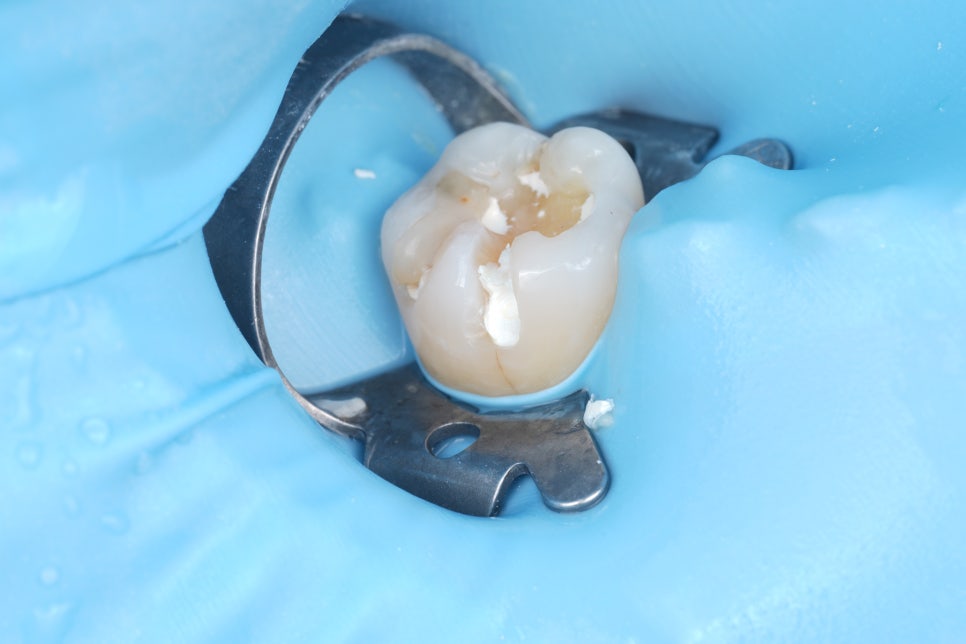 교대역치과 타치과 신경치료, 크라운 진단받았으나 레진으로 치료 관련 이미지 20