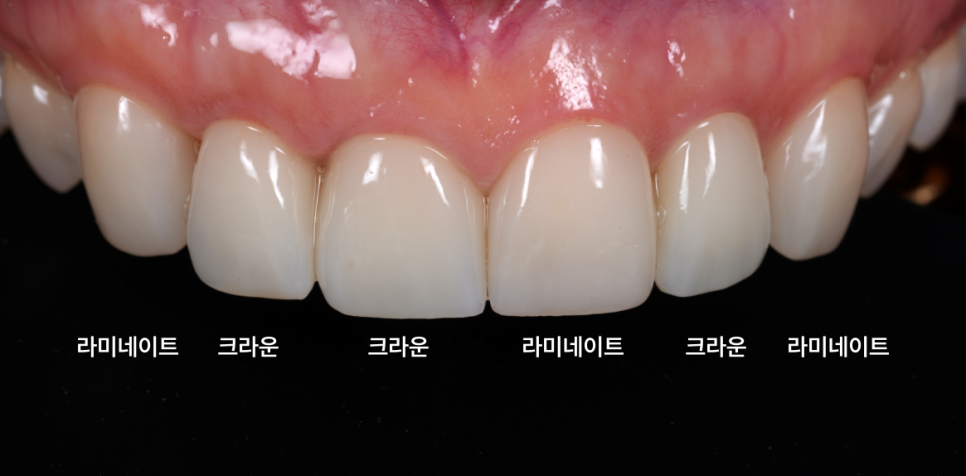 라미네이트, 크라운 재치료, 잇몸 성형까지 앞니 6개 치료 관련 이미지 13