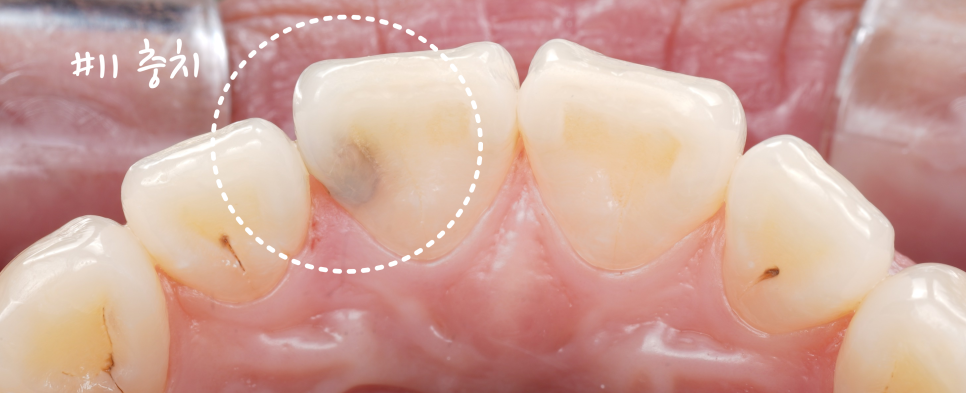 교대역치과 타치과 신경치료, 크라운 진단받았으나 레진으로 치료 관련 이미지 3