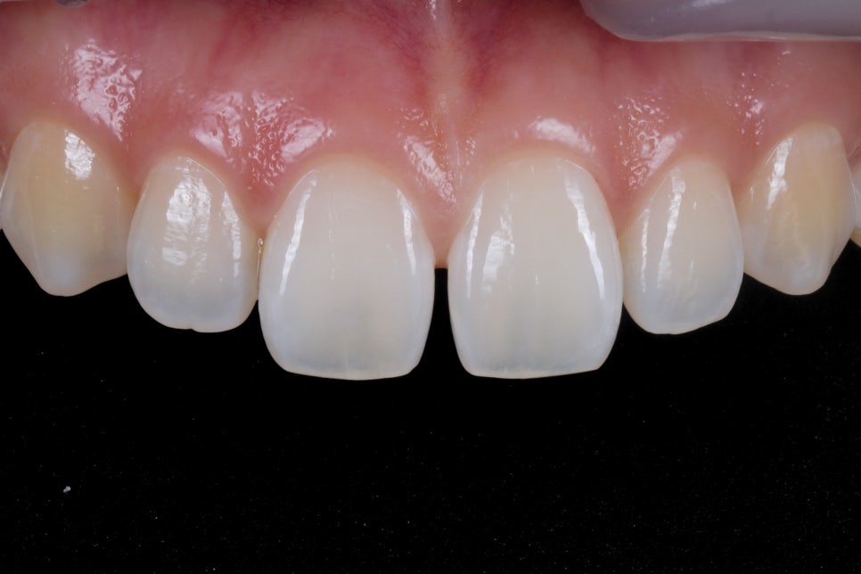 앞니 벌어짐 레진으로 삭제없이 충분히 예쁘게 할 수 있어요 관련 이미지 6