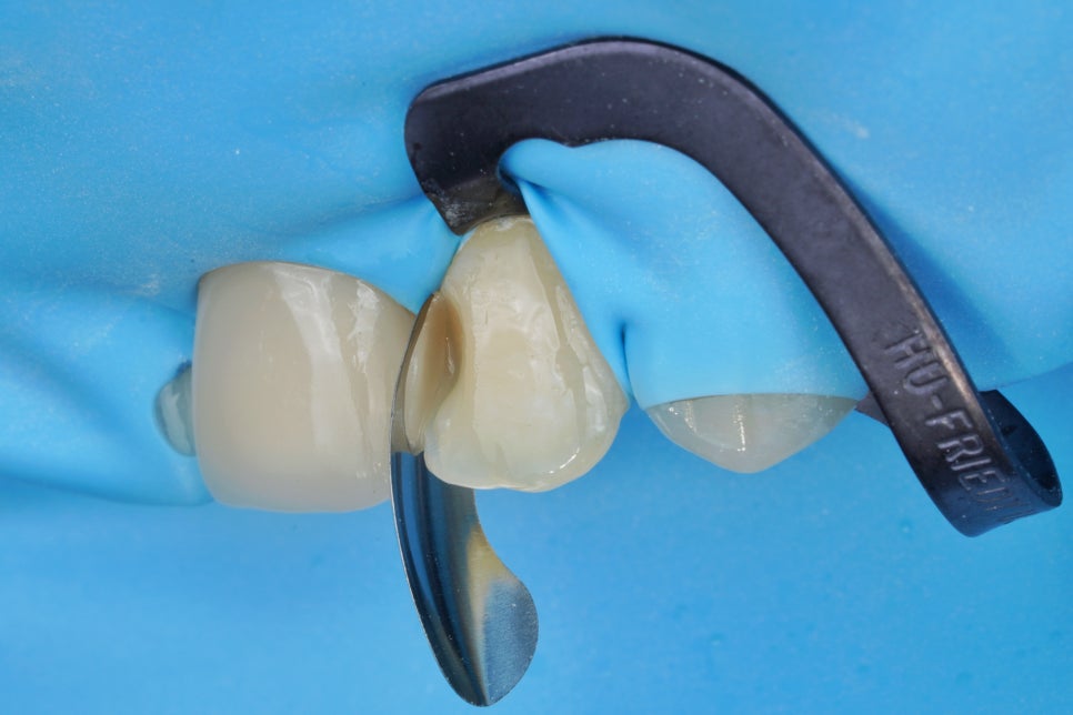 서초동 앞니 사이 충치, 기존 레진 제거 후 다시 치료 했습니다. 관련 이미지 3