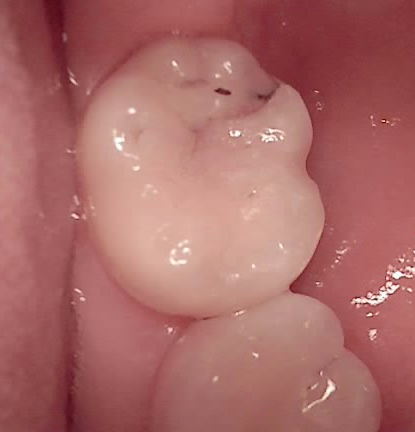 교대역 치과 보철 아래 2차 충치를 다시 레진으로 관련 이미지 15