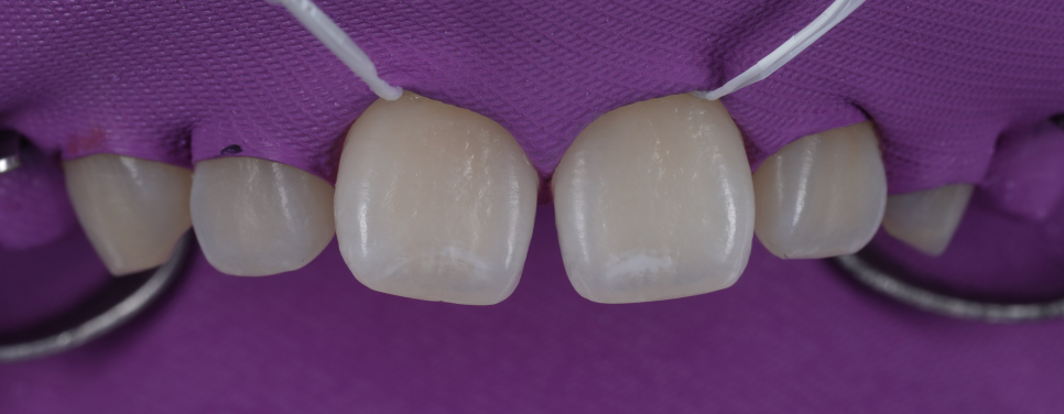 방배동치과 앞니 벌어짐 해결하러 강릉에서 오셨어요 관련 이미지 8