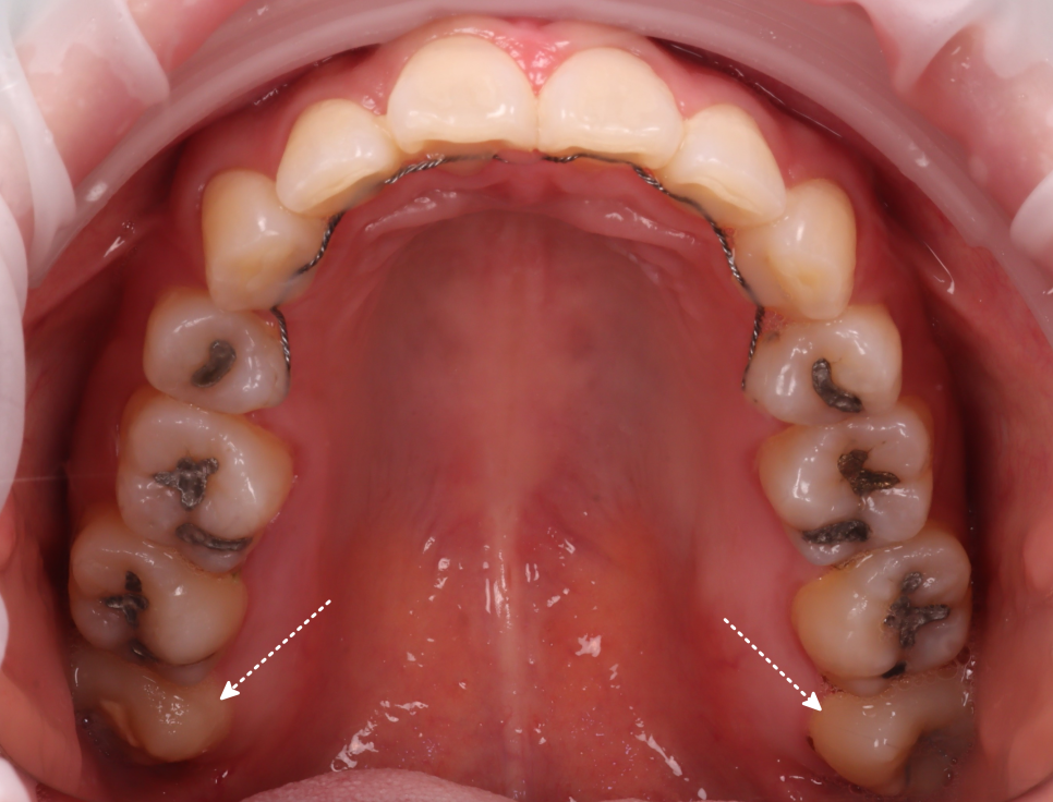 사랑니발치 매복 돼도 이렇게 빼면 안전해요 관련 이미지 3