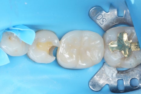 신경치료 할법한 어금니를 레진 빌드업으로 살려가는 이유 관련 이미지 3