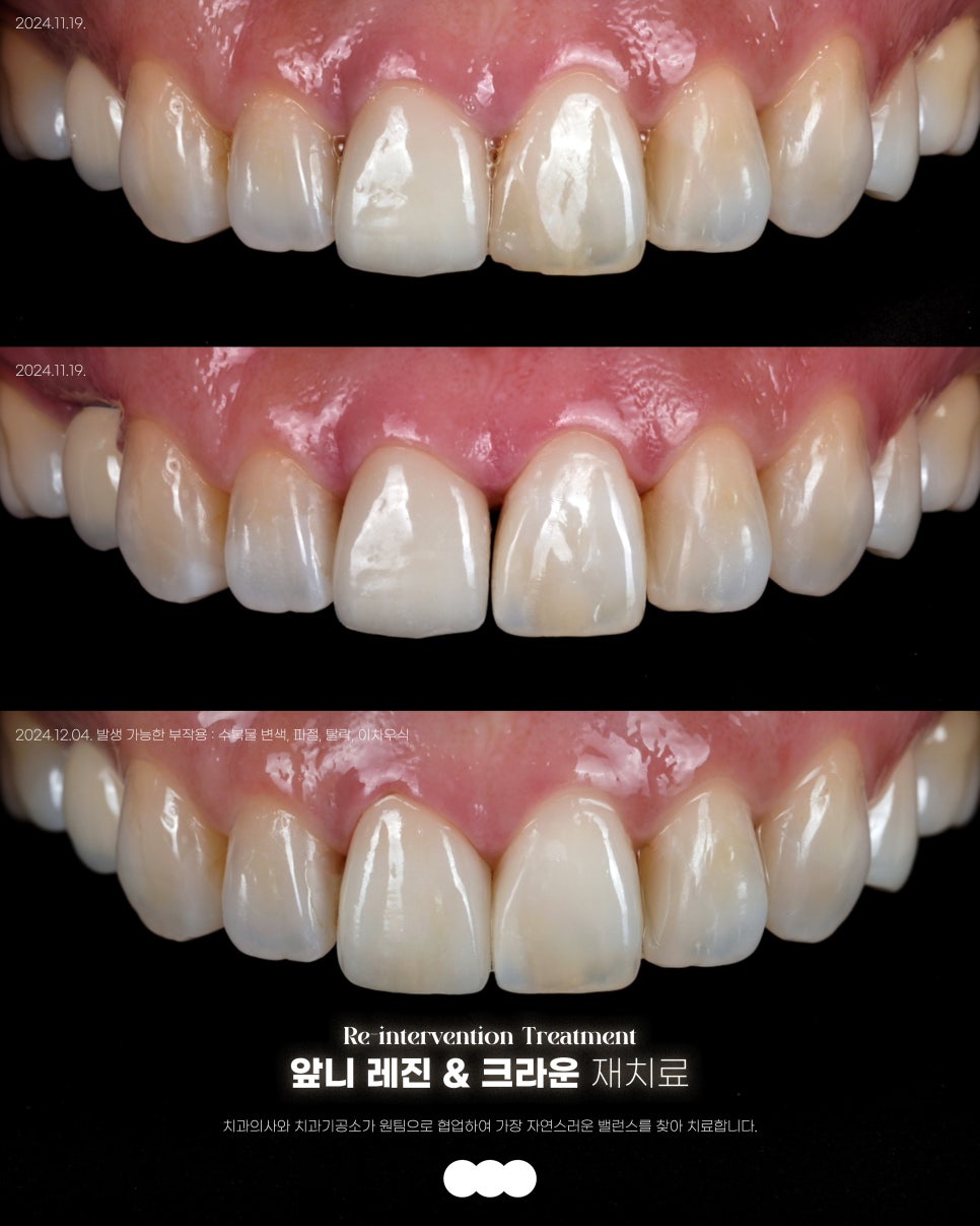 반포동 앞니 크라운, 레진 교체로 인상이 바뀐 후기 관련 이미지 1