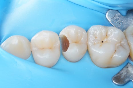 신경치료 할법한 어금니를 레진 빌드업으로 살려가는 이유 관련 이미지 2