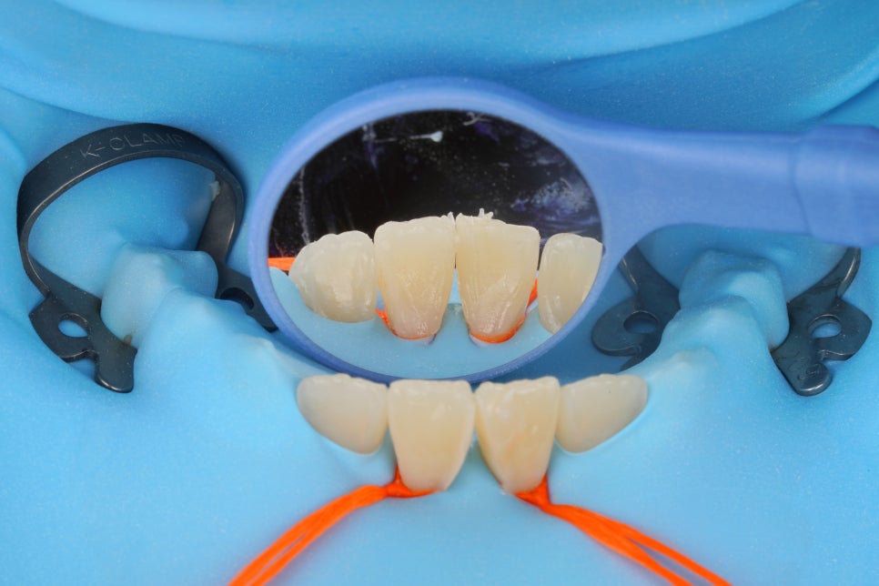 앞니 벌어짐 레진 당일 치료, 앞니 레진 잘하는 서초동 치과 관련 이미지 7