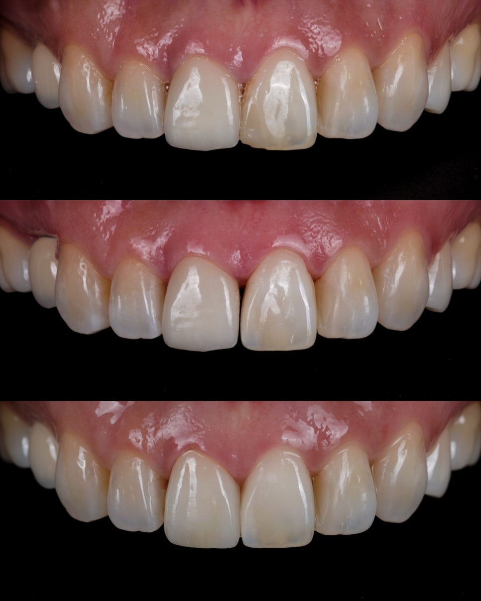 앞니 레진 라미네이트, 1시간 원데이 치료가 가능한 교대 치과 관련 이미지 7