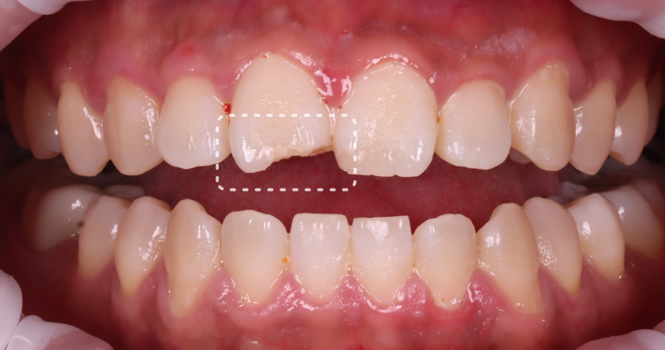 반포동치과 앞니 깨짐 레진 삭제 없이 당일에 치료 끝 관련 이미지 5