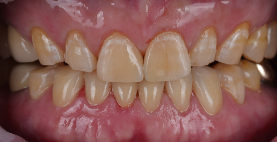 신논현역치과 심하게 마모된 60대 남성 앞니 크라운 치료 관련 이미지 14