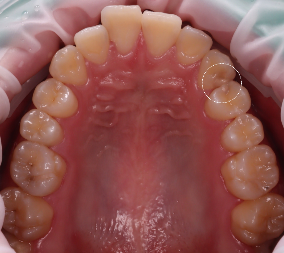 역삼역 치과 치대생 깊은 충치 신경치료없이 레진으로 완료 관련 이미지 6