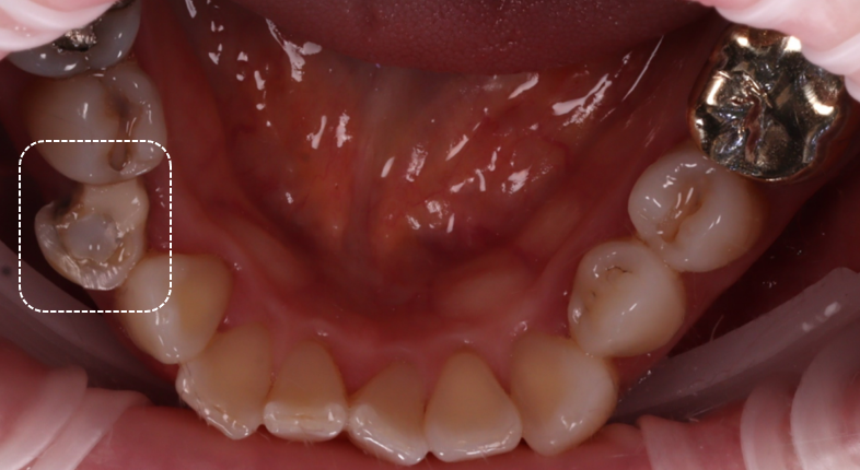 잘못된 앞니 레진 뼈까지 녹인다? 레진 재치료 과정 관련 이미지 3