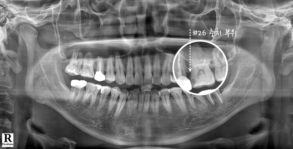 Do Cavities Between Teeth at Sinsa Station Dental Clinic Have to Be Treated with an Inlay? Resin Is Also an Option image 4