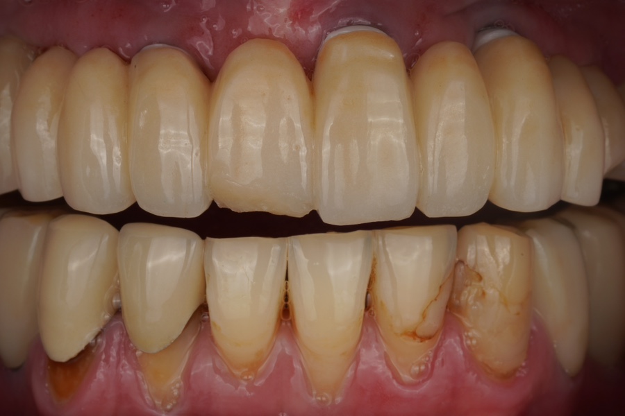 전체임플란트 지르코니아 PFZ 보철 수리해드린 교대역 치과 관련 이미지 1