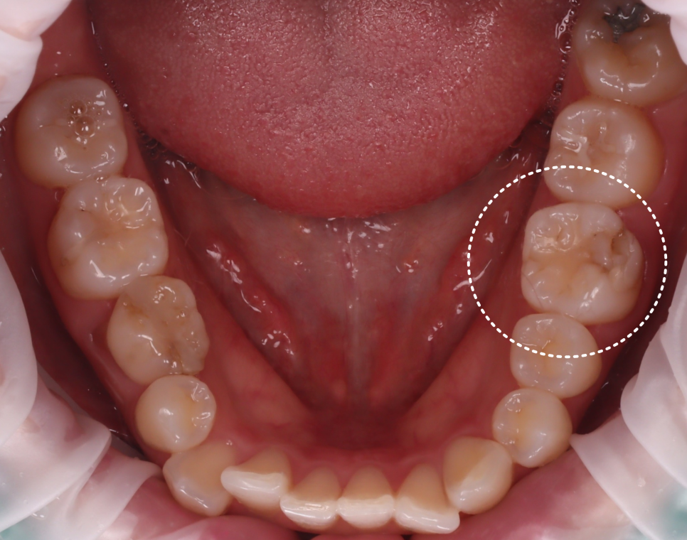 Jamnwon-dong Dental Clinic: Don’t Grind Down Your Teeth—Get Resin Build-up Instead image 3