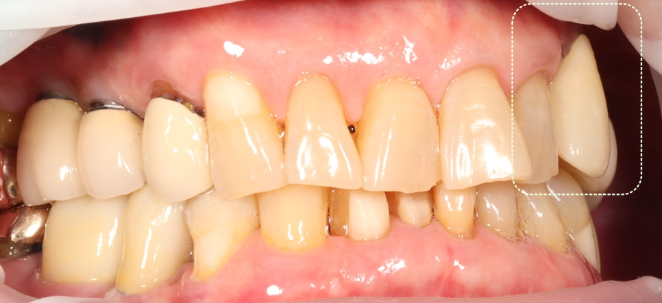 선릉역치과 타원 앞니 임플란트 빼고 재수술 해드린 이유 관련 이미지 4