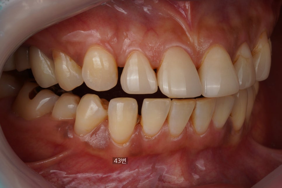 20년 전 때운 레진 떨어짐으로 이 사이 벌어짐 치료 : 교대역 치과에서 당일 레진 관련 이미지 2
