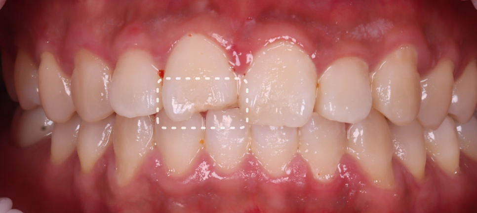 반포동치과 앞니 깨짐 레진 삭제 없이 당일에 치료 끝 관련 이미지 2