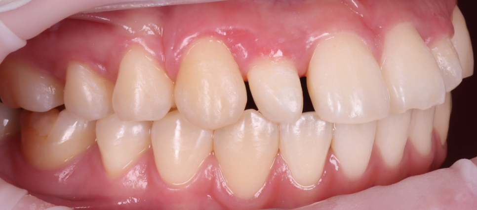 Seocho Dental Clinic Case of Gummy Contouring and Resin Treatment for a Peg Lateral Tooth in an Out-of-Town Dental Hygienist image 5